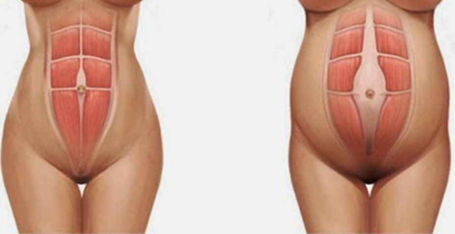 Diástasis abdominal