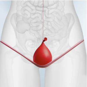 Imagen incontinencia urinaria